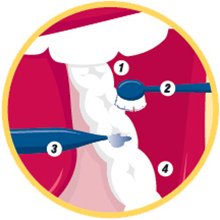 dental sealants diagram